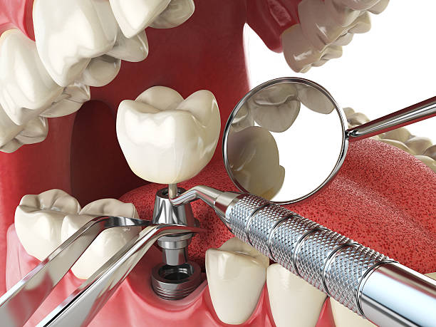 Best Broken or Cracked Tooth Emergency Dentist in Sanatoga, PA